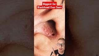 Worlds Biggest EAR BLACKHEAD REMOVAL #shorts