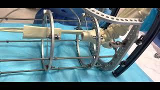 Truelok Circular Fixator for Bone Transport for Orthoplastic Approach