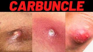 What is Carbuncle? Carbuncle Definition, Symptoms, Causes, Treatment, USMLE