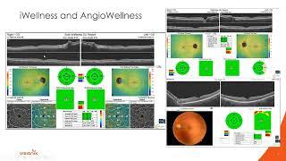 Glaucoma Management & The Optovue Solix by Visionix - Dr. Nate Lighthizer