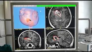 предоперационное планирование. Нейронавигация.