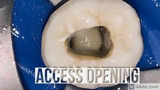 Mandibular Molar Access opening