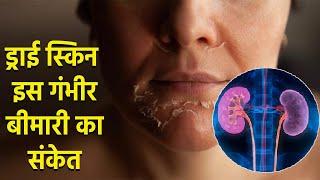 Dry Skin होना इस गंभीर बीमारी का संकेत | Dry Skin can be sign of this Disease | Boldsky