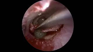 Tympanoplasty: Ear drum hole repair