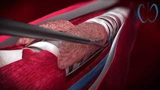 3D Medical Animation - TOETVA TransOral Endoscopic Thyroidectomy Vestibular Approach