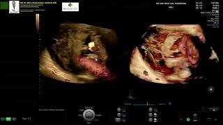 ABDOMINAL prenancy - live 14 weeks (Dr. Wiku Andonotopo)