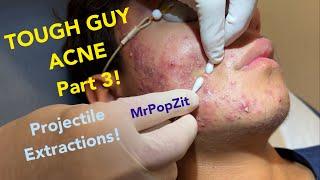 Tough Guy Acne part 3! Projectile extractions, very poppy. Follow his progress,links in description