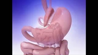 The Mini Gastric Bypass procedure  Explained