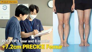 Limb Lengthening 7.2cm with PRECICE and athletic ability recovery after 1 year and 8 months after