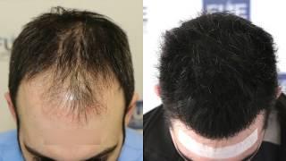 FUE Hair Transplant (3467 + 1000 grafts in NW - Class IV - A), Dr. Juan Couto - FUEXPERT CLINIC