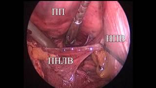 Thoracoscopic ablation for atrial fibrillation