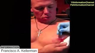 Treatment video 2016 | Monster botfly and mangoworms in human treatment | Botfly removal vol 4 3