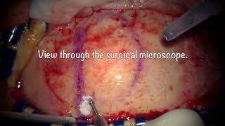 Surgical resection of brain tumor (meningioma).  Complete video presentation.