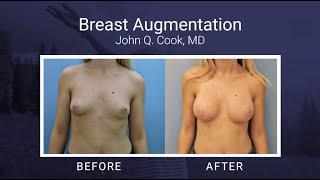 Defining a Successful Breast Augmentation