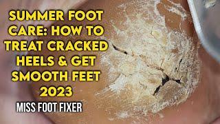 Summer Foot Care: How to Treat Cracked Heels and Get Smooth Feet by foot Specialist Miss foot Fixer