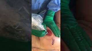 Nipple and areola tattooing