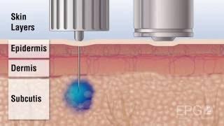 Инъекция из дюзы InsuJet ™ (инсужет) против иглы Needle vs InsuJet™ Nozzle injection