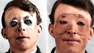 The Tragic History of WW1 Plastic Surgery