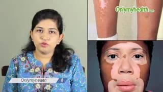 How to recognize vitiligo symptoms - Onlymyhealth.com