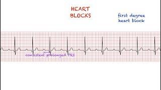 Heart Blocks Interpretation: Easy and Simple