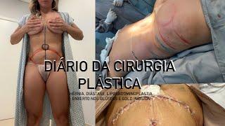 Diário da cirurgia plástica - pós operatório