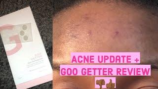 Goo Getter Zitsticka Review on my Acne + Forehead & Skin Update | My 2021 New Year Skin Resolutions