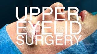 WILL'S UPPER EYELID BLEPHAROPLASTY | COSMETIC SURGERY | SIGNATURE CLINIC, LONDON | VLOG