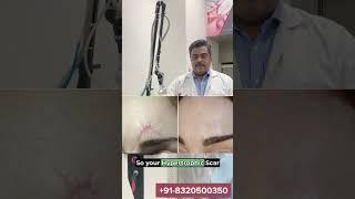 CO2 Fractional Laser Treatment | Keloid Scars | Dr. Ashutosh Shah | Elegance Clinic - Surat