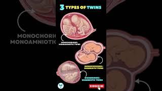3 Types of Twins   Twin Pregnancy | Different types of Twins #shortsfeed #pregnancy #baby #twin