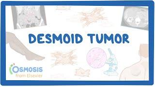 Desmoid Tumor (NORD)