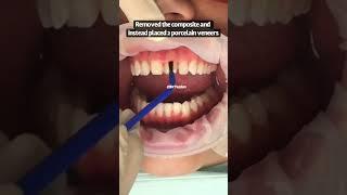 Composite bonding vs. porcelain veneers | porcelain veneers procedure | dental veneer before after