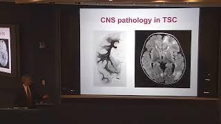 Mustafa Sahin   Tuberous Sclerosis  Shedding Light on the Neural Circuitry of Autism Oct 5, 2018