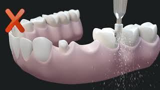 Восстановление зубного ряда с использованием мостовидного протеза