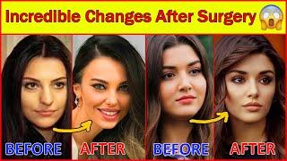 20 Turkish Actresses Before and After Surgery , Plastic Surgery, Turkish Drama