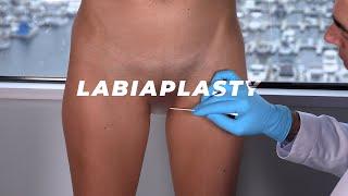 6-Week Post-Op Labia Minora & Clitoral Hood Reduction | Dr. David Stoker Los Angeles Plastic Surgeon