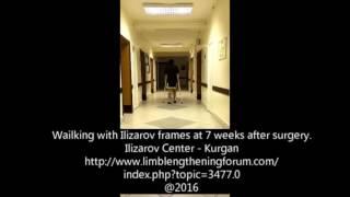 Walking with ilizarov seven weeks after surgery Kurgan