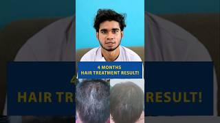 4 Months Hair Treatment Result with Adon! | Hair Loss | Hair Regrowth| Hair Journey #viral #adon