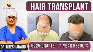  Hair Transplant Journey: 5000 Grafts with 1 Year Results | Best Hair Transplant in Delhi NCR