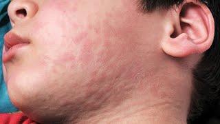 urticaria or hives in Nepali