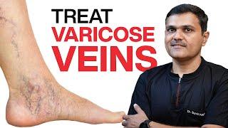 11 ways to TREAT VARICOSE VEINS: Insights from a vascular surgeon.