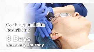 Co2 Laser Fractional Skin Resurfacing 8 Day Recovery Journey  | Before&After | CMC NSW