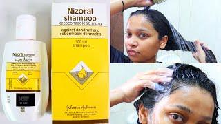 How to use Nizoral shampoo for effective results