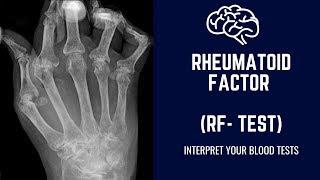 Rheumatoid Factor Test ( RF Test) :Diagnosis of  Rheumatoid Arthritis: Normal Range & Interpretation
