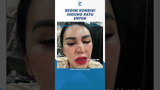 Viral Bangun Tidur Hidung Selebgram Ratu Entok Asimetris, Kenapa? #shorts