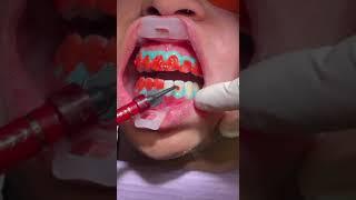 NEW Teeth Whitening Procedure at View Mobile Dental | Arnold Paulos DDS