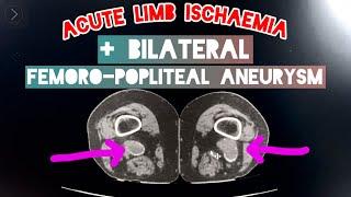 Acute Limb Ischaemia (ALI) Stage 2B with Bilateral Femoro-Popliteal Aneurysm