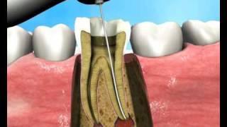 The Apexum Procedure- root canal treatment, produced by Virtual Point