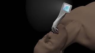Introducing the i-view™ video laryngoscope from Intersurgical