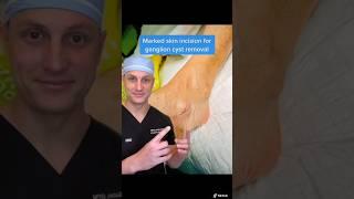 Ganglion Cyst RemovalWatch Dr.Galan skillfully remove this ganglion cyst