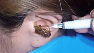 The Most Massive Earwax Removed in One Scoop